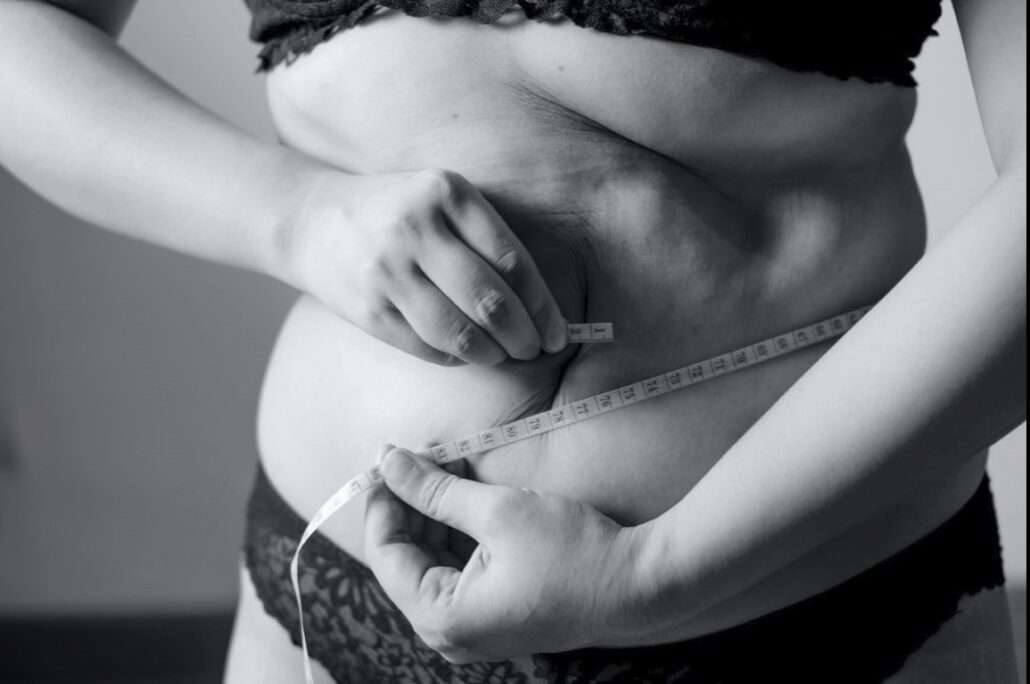 Liposucción láser en Tolima (Colombia): un método eficaz para reducir grasa localizada